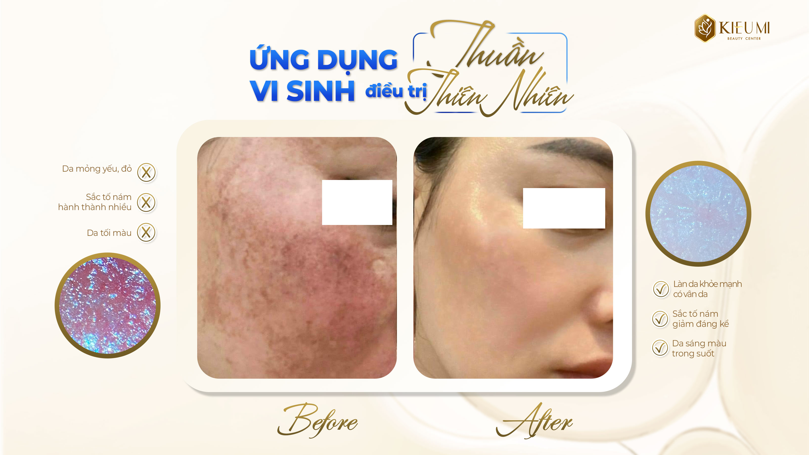  Khám phá liệu trình điều trị Nám Da Toàn Diện cùng Kiều Mi Beauty 