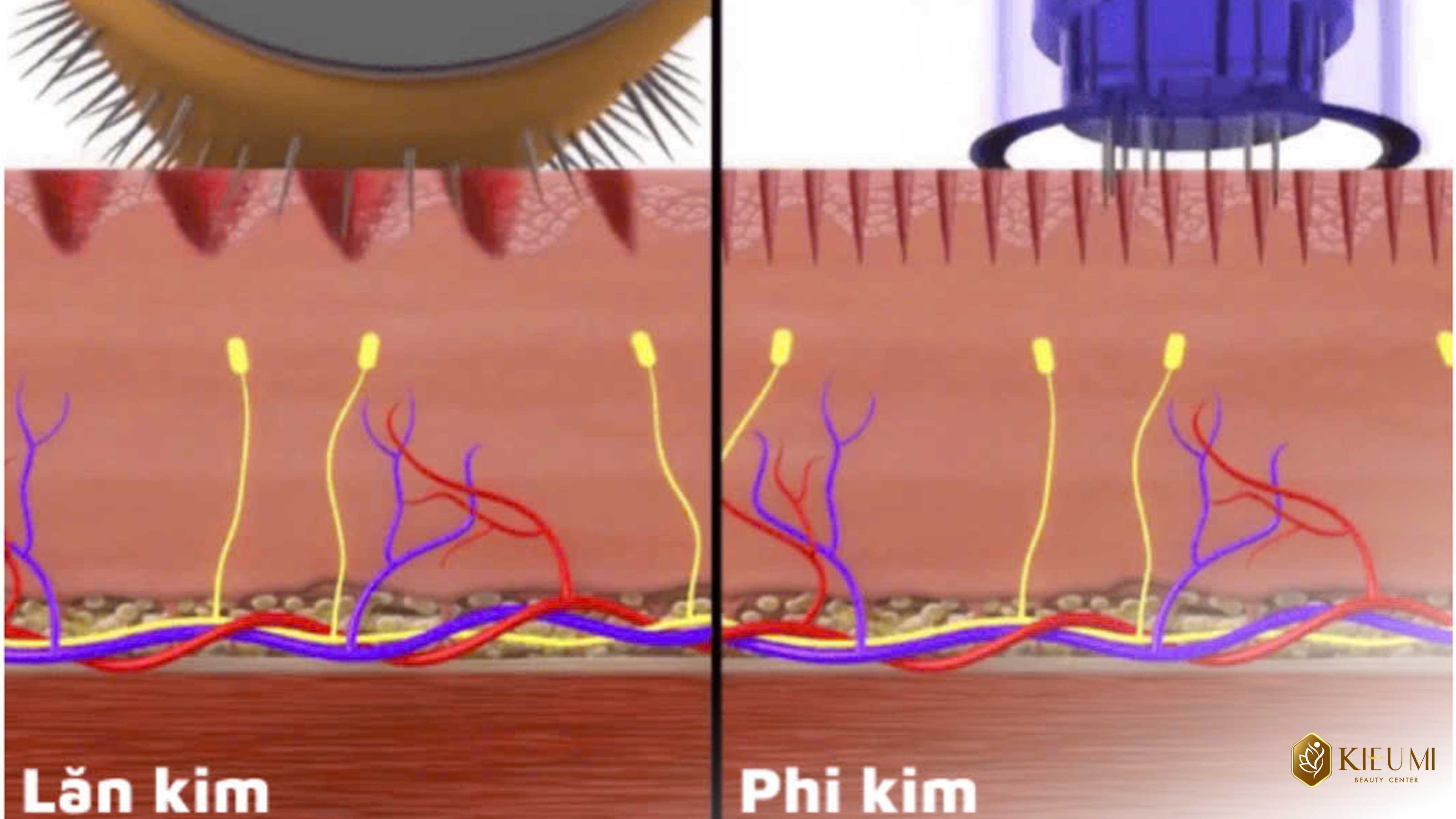  Sự khác biệt của công nghệ Lăn kim và Phi kim tại Liệu trình điều trị da Kiều Mi  