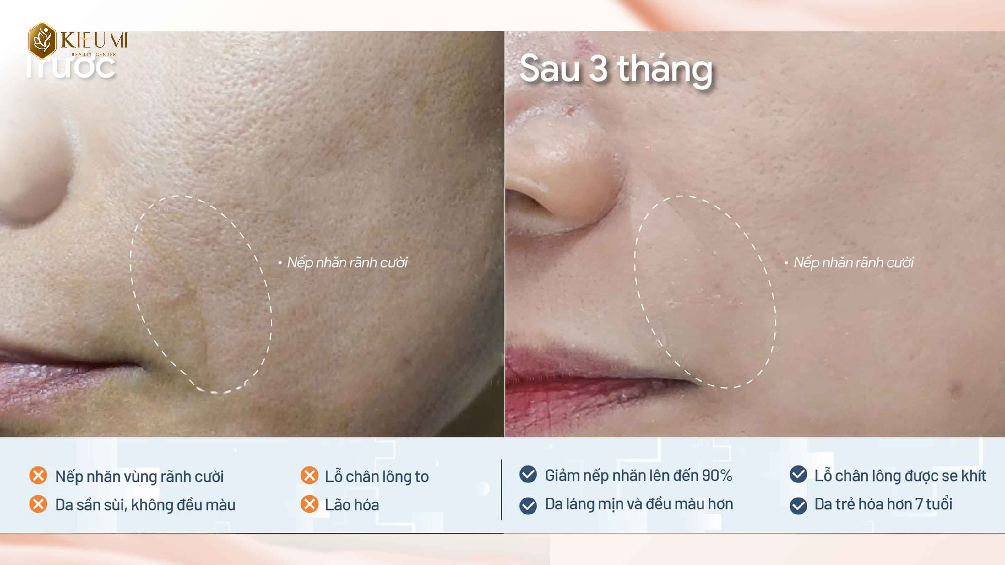 TÁI SINH LÀN DA LÃO HOÁ BẰNG LIỆU TRÌNH XOÁ NẾP NHĂN TẠI KIỀU MI BEAUTY CENTER