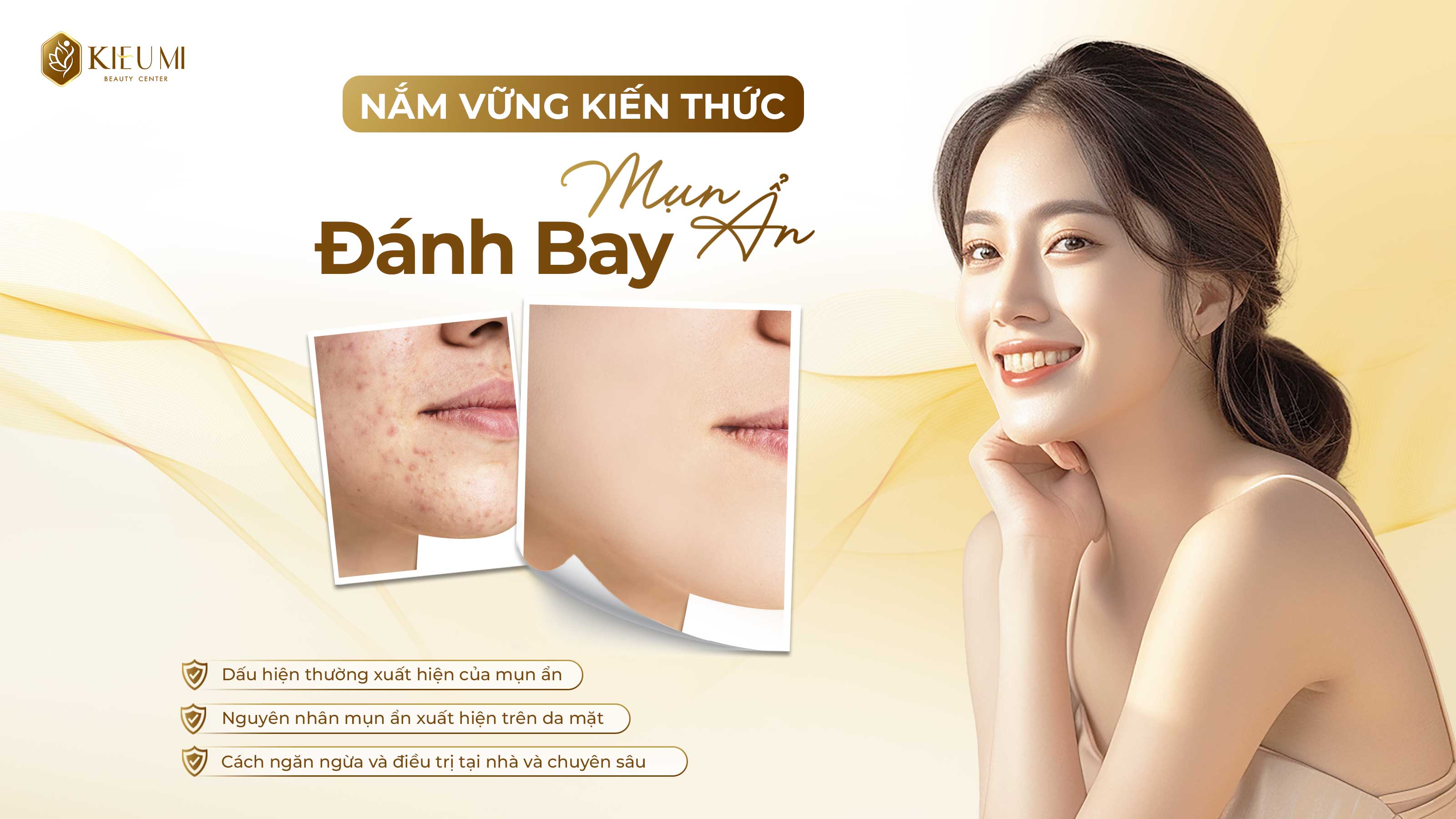  Mụn ẩn là gì? Cách ngăn ngừa và điều trị mụn ẩn hiệu quả cùng Kiều Mi Beauty   