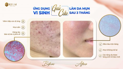  Ứng dụng công nghệ vi sinh trong chăm sóc da tại Kiều Mi 