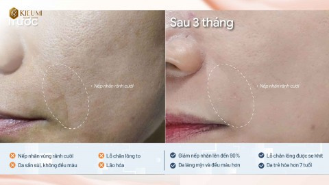  TÁI SINH LÀN DA LÃO HOÁ BẰNG LIỆU TRÌNH XOÁ NẾP NHĂN TẠI KIỀU MI BEAUTY CENTER